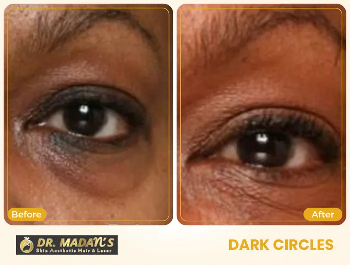 Dark circles before and after result 4 at Dr Madan Aesthetics